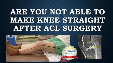 A Miraculous Recovery: 8 Months After ACL Surgery